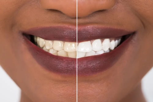 Teeth Whitening 3