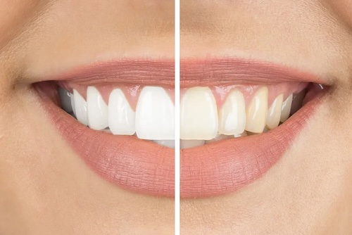 Teeth Whitening 4