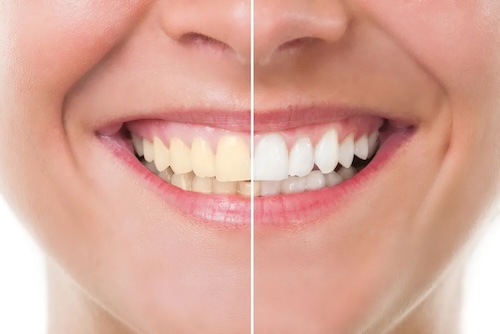 Teeth Whitening 5